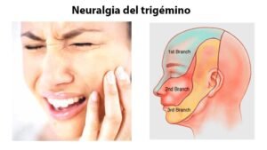 DÍA INTERNACIONAL DE LA NEURALGIA TRIGEMINAL: CONOCIENDO EL “DOLOR MÁS FUERTE DEL MUNDO”